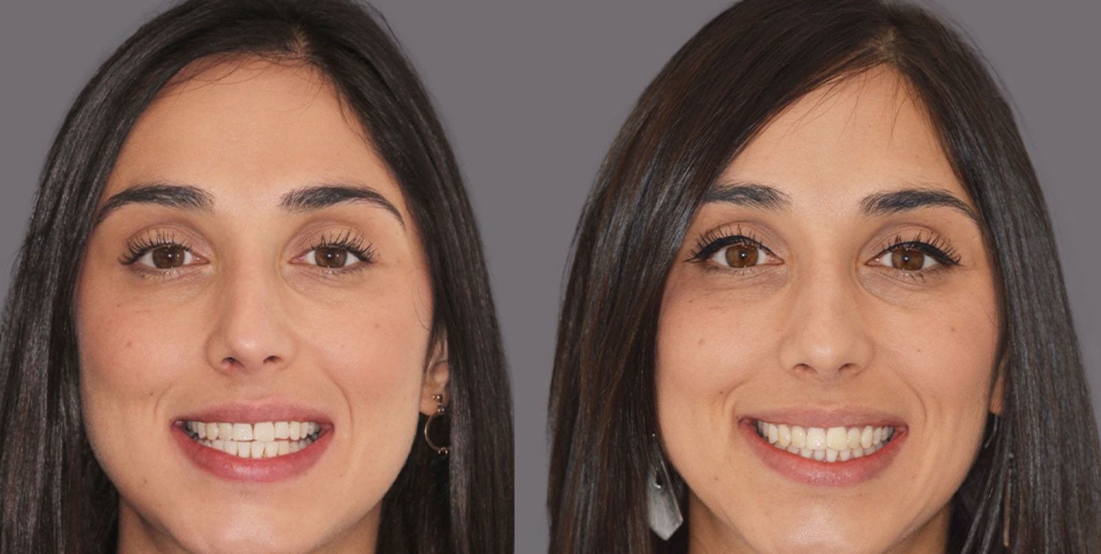 Före och efter Invisalign, fall 1