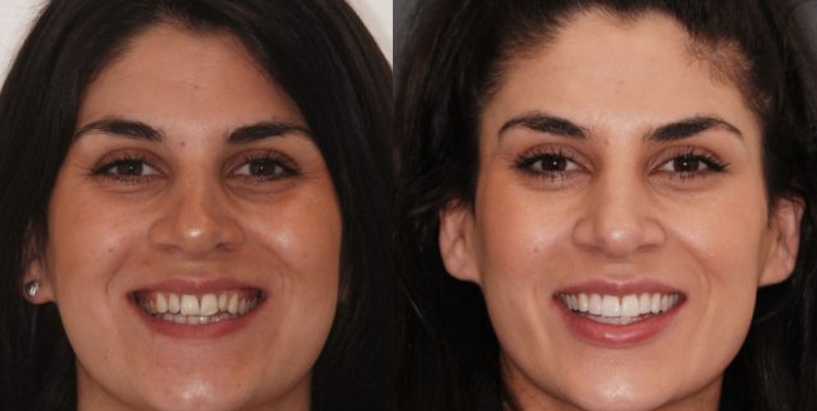 Före och efter Invisalign, fall 2