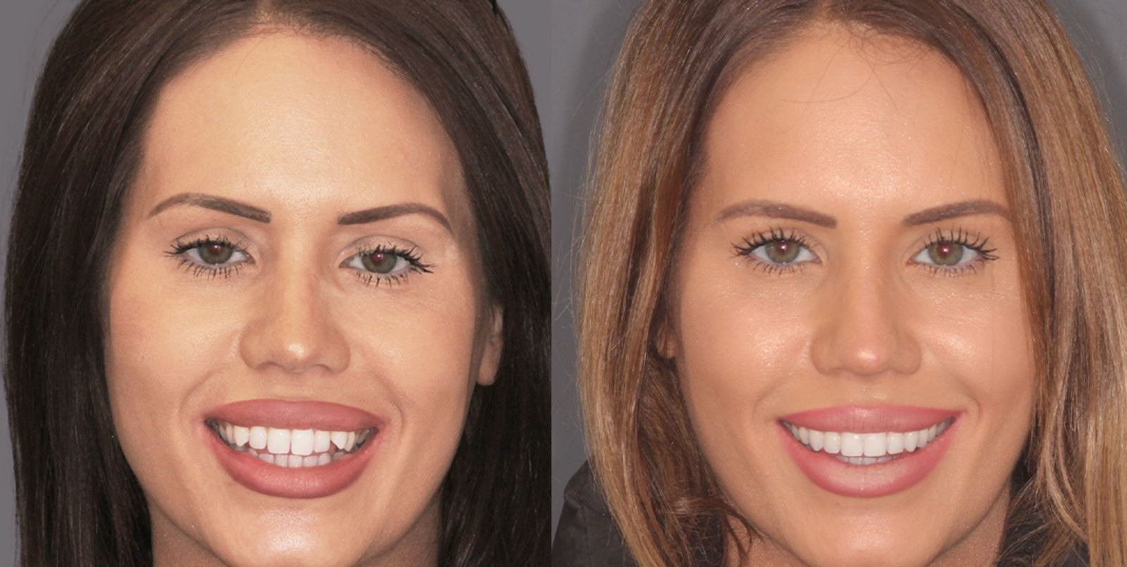 Före och efter Invisalign, fall 3